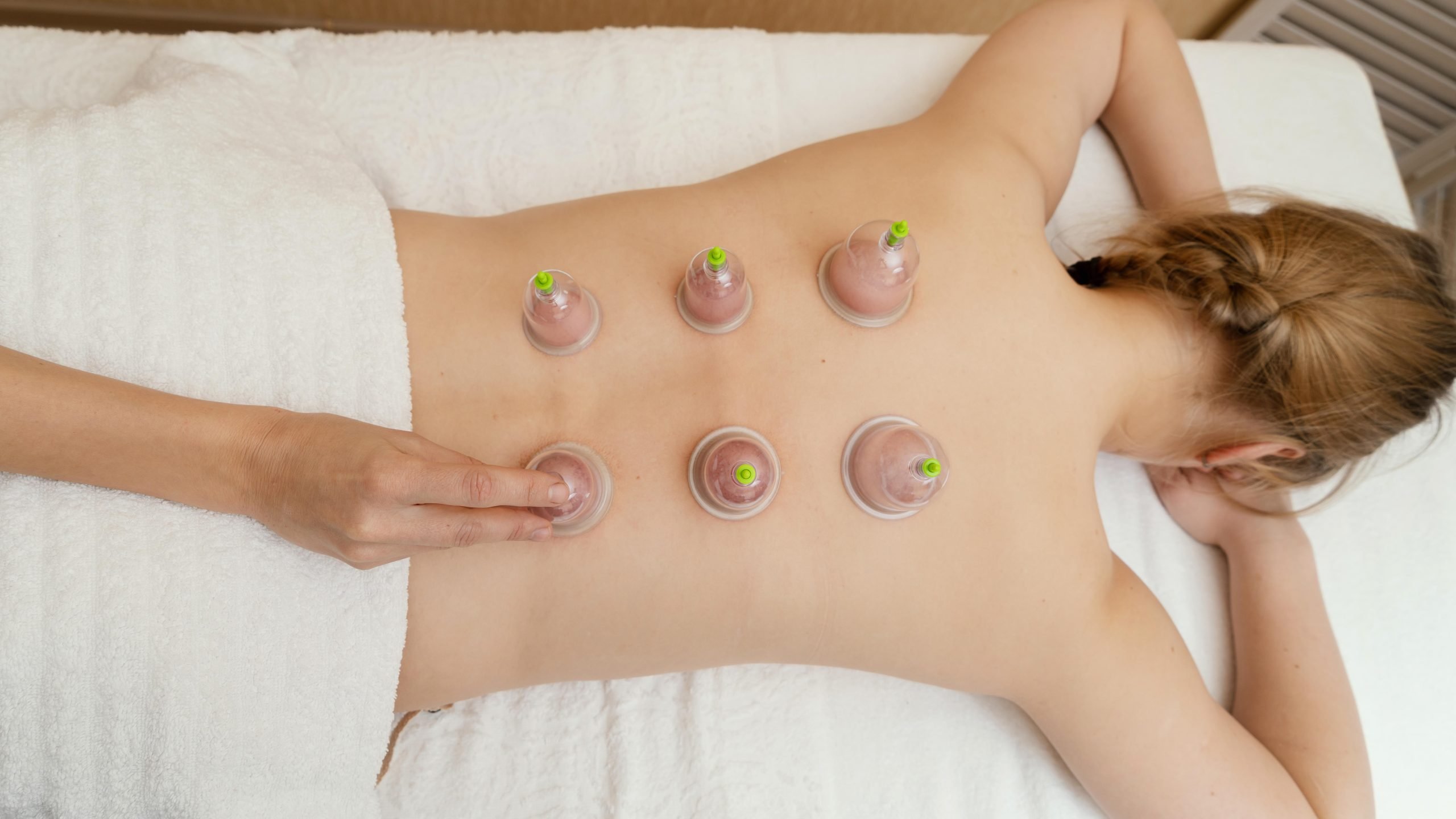 Cupping ( Hijama )